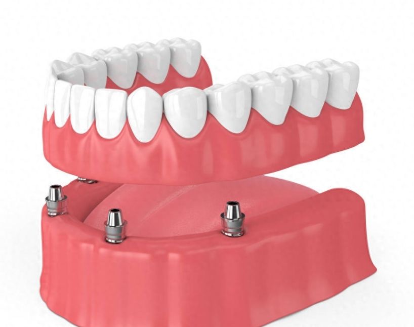 Dentium种植牙优惠，疗程费用低至220元，限时享！
