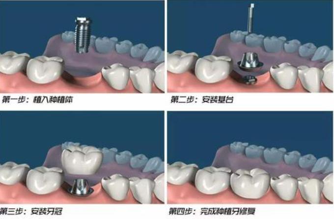 重庆暑期优惠：维乐口腔矫正治疗让您牙齿完美，价格实惠！