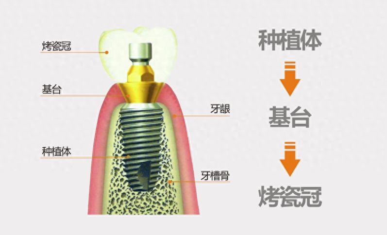南宁牙齿矫正所需的常规费用是多少？详解正畸步骤及可信赖的牙科机构