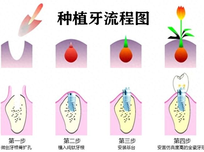 兰州诺贝尔口腔矫正费用惊喜，仅需5千多！