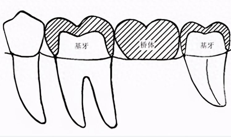 德国瑞西欧ht种植牙价格及先锋系列性价比对比