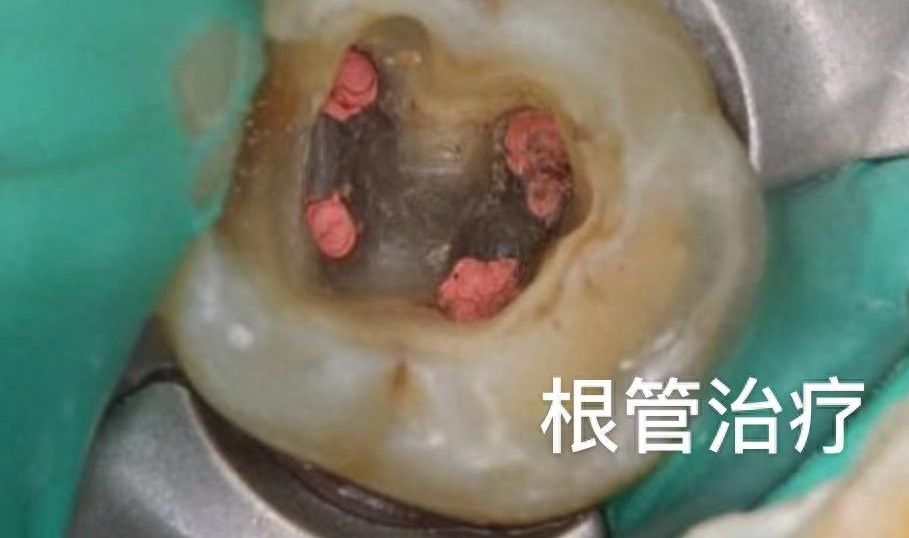 苏州美奥口腔正畸治疗你是否可以负担得起？快速了解金属、隐形牙套矫正价格