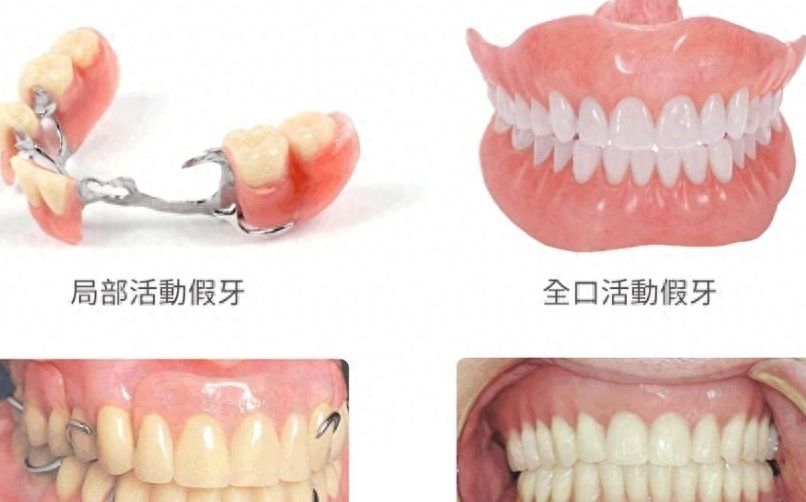 宜昌中汉口腔种植牙价格低至2780元，开口可烤瓷冠