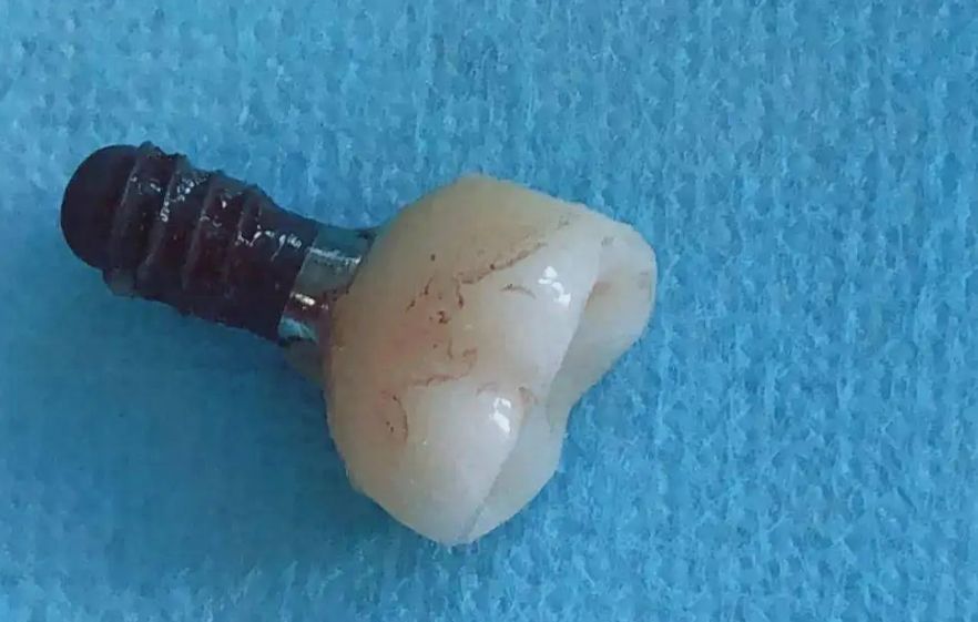 杭州下城区口腔医院优惠活动：种牙价格惊喜！