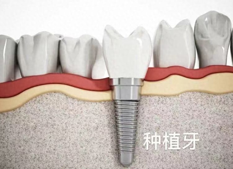 漳州博恩口腔种植牙价格低至3980元，享受优惠