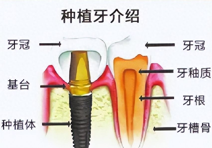 韩国icm种植牙：优点、缺点和价格解析