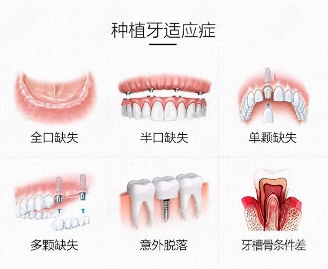 兰州张掖路口腔诊所种植牙收费公示，惊喜价揭秘