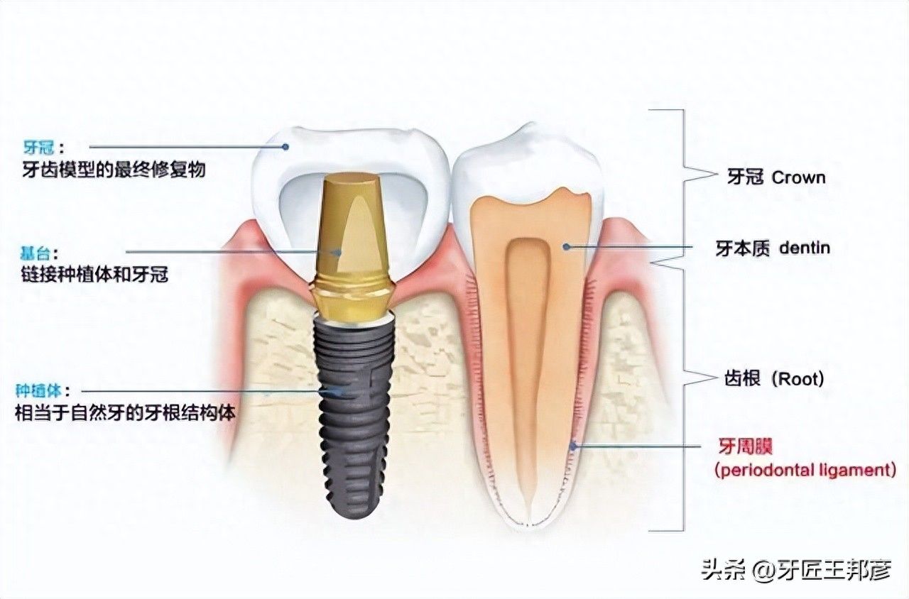 拉萨种植牙价格比较实惠，你了解吗？