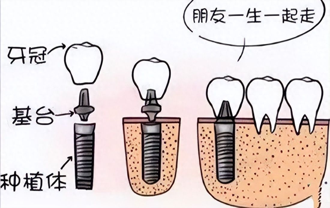 昆明美奥口腔：隐适美极速版igo价格大幅降价，赶快抢购！