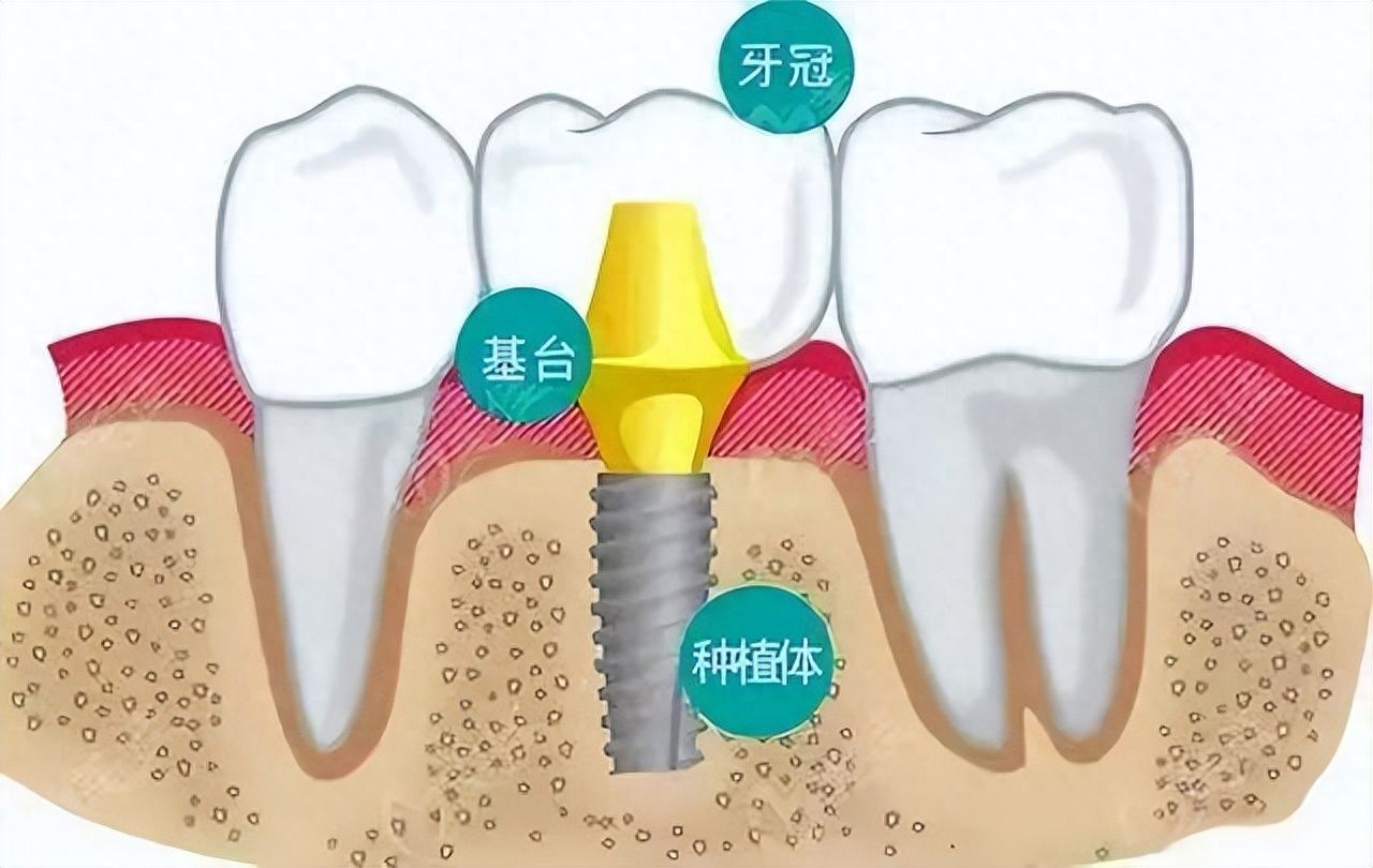 国产牙齿种植体性能评测与推荐：品牌综合排行及价格对比