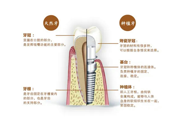 上海尤旦口腔：金属矫正收费及诺贝尔种植牙价格详解