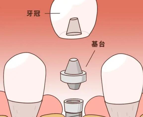 珠海哪里可以进行牙齿美白？牙齿美白费用如何？