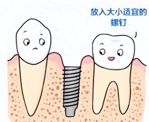 黄金烤瓷牙价格及影响核磁共振的情况解析