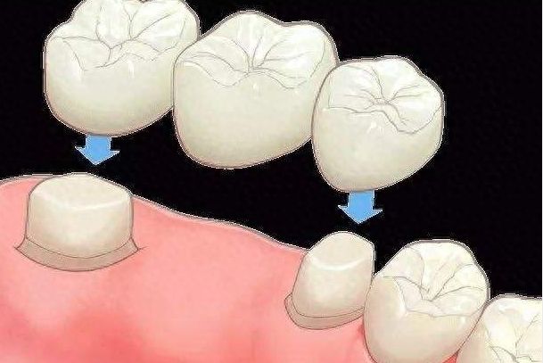 成都曼斯特口腔服务收费一览：种植牙、牙齿矫正、牙贴面价格对比