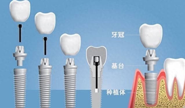 保定市妇幼保健院口腔科综合评价及种植牙案例与价格表详解