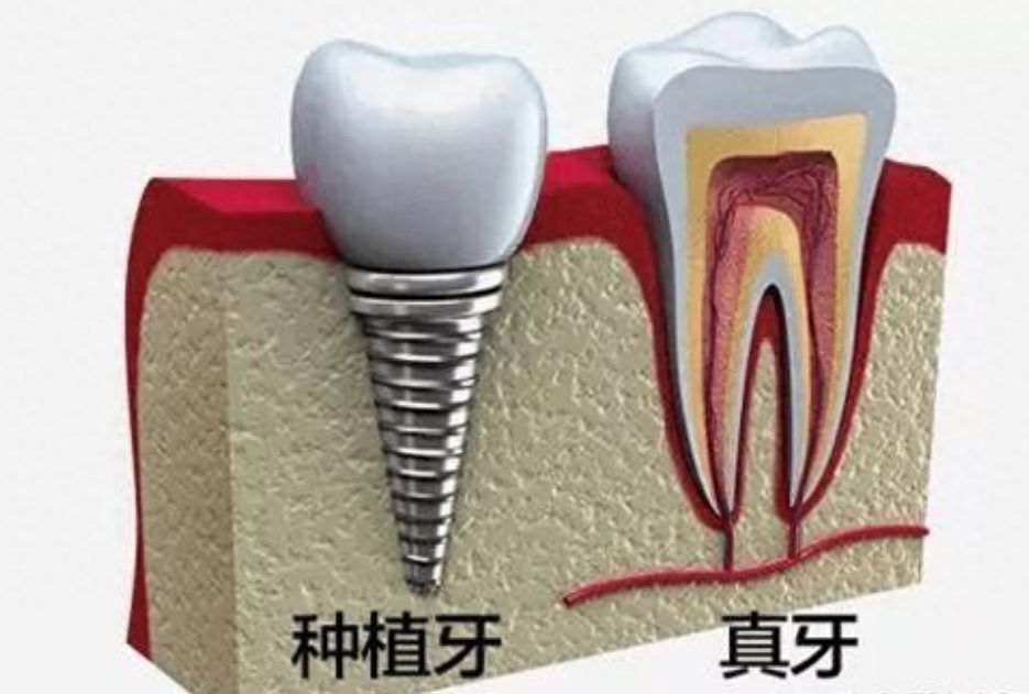 徐州紫浩口腔种植牙价格：韩系、登腾、ITI比2380、3880、8880更实惠