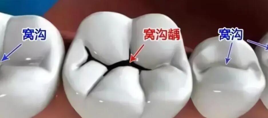 解读济南维乐口腔的种植牙价格与首颗半价活动是否有效