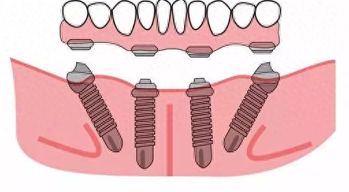 如何合理控制牙齿矫正预算？详解费用因素和矫正方案