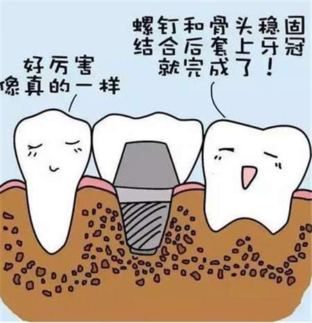 钴铬钢牙牙套的价格及优缺点详解，钴铬钢牙牙套购买指南